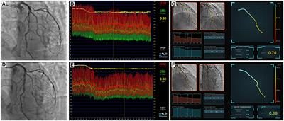 Agreement of Angiography-Derived and Wire-Based Fractional Flow Reserves in Percutaneous Coronary Intervention